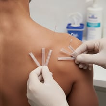 הטכניקה הטיפולית והכלים המשמשים בדיקור מערבי